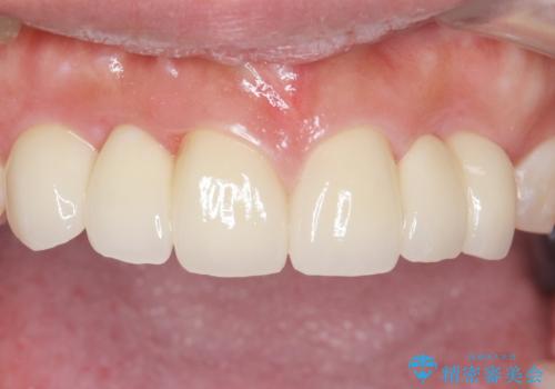 歯の位置異常 はやく治したい 矯正は嫌 20代女性の治療後