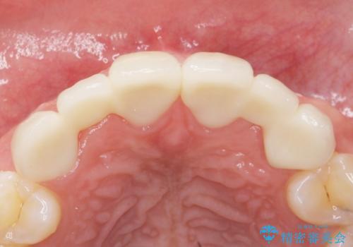 歯の位置異常 はやく治したい 矯正は嫌 20代女性の治療後