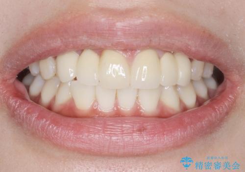 歯の位置異常 はやく治したい 矯正は嫌 20代女性の治療後