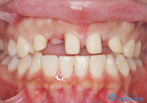 歯の位置異常　はやく治したい　矯正は嫌　20代女性の治療中