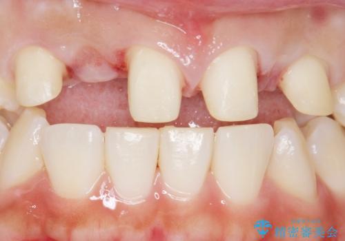 歯の位置異常 はやく治したい 矯正は嫌 20代女性の治療中