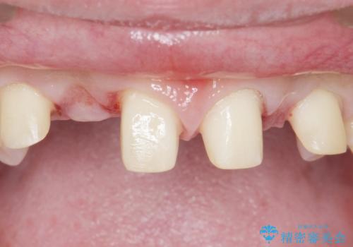 歯の位置異常 はやく治したい 矯正は嫌 20代女性の治療中