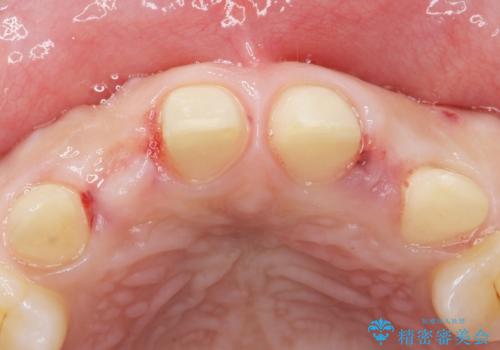 歯の位置異常 はやく治したい 矯正は嫌 20代女性の治療中