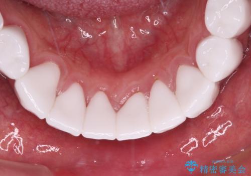 とにかく作り物のような真っ白な歯にしたい フルジルコニアクラウンによる補綴治療の治療後