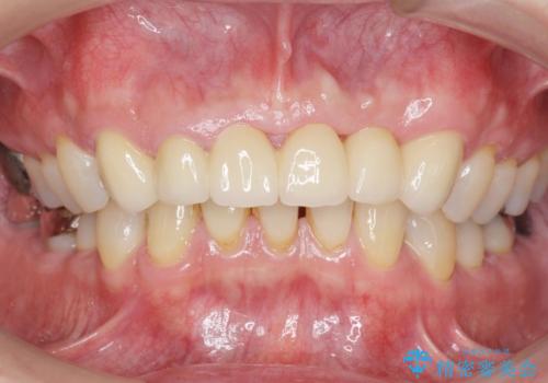 転んで前歯が2本ぬけた 自然なブリッジへ 60代男性の治療後