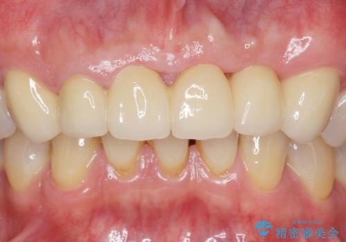 転んで前歯が2本ぬけた 自然なブリッジへ 60代男性の治療後