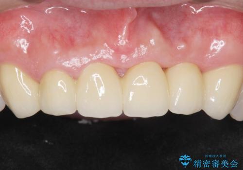 転んで前歯が2本ぬけた 自然なブリッジへ 60代男性の治療後