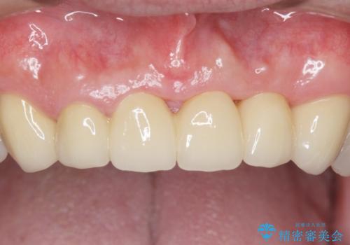 転んで前歯が2本ぬけた 自然なブリッジへ 60代男性の治療後