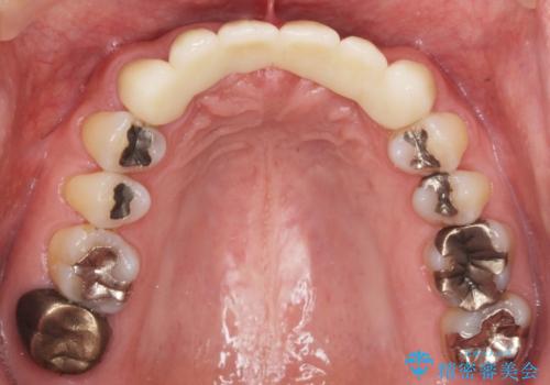転んで前歯が2本ぬけた 自然なブリッジへ 60代男性の治療後