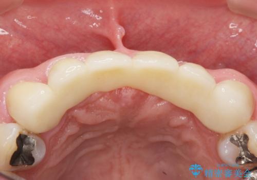 転んで前歯が2本ぬけた 自然なブリッジへ 60代男性の治療後