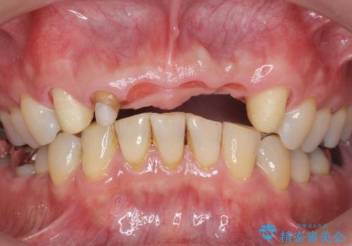 転んで前歯が2本ぬけた 自然なブリッジへ 60代男性の治療中