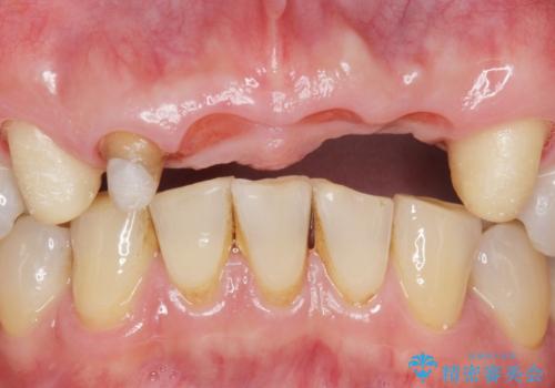 転んで前歯が2本ぬけた 自然なブリッジへ 60代男性の治療中