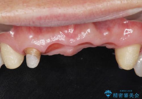 転んで前歯が2本ぬけた 自然なブリッジへ 60代男性の治療中
