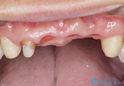 転んで前歯が2本ぬけた 自然なブリッジへ 60代男性の治療中