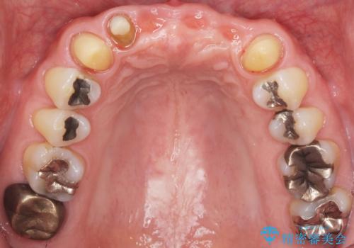 転んで前歯が2本ぬけた 自然なブリッジへ 60代男性の治療中