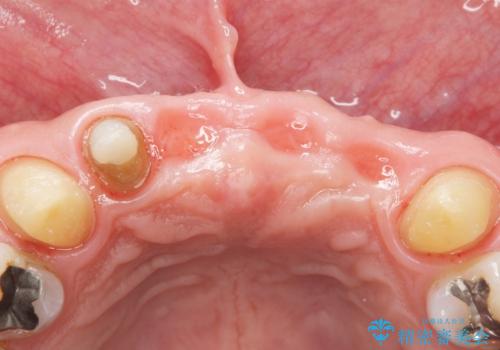 転んで前歯が2本ぬけた 自然なブリッジへ 60代男性の治療中