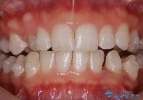 インビザライン中に見える所だけ綺麗にしたいの治療後