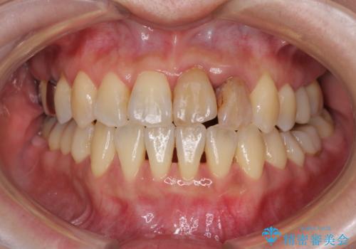 反対咬合で痛む前歯を改善 インビザラインによる矯正治療の治療中