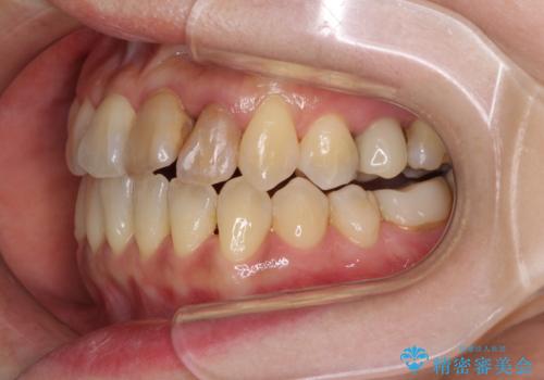 反対咬合で痛む前歯を改善 インビザラインによる矯正治療の治療中