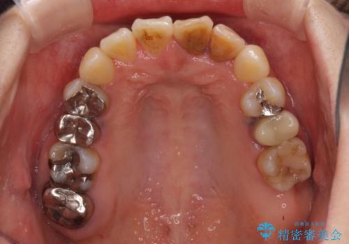 反対咬合で痛む前歯を改善　インビザラインによる矯正治療の治療中