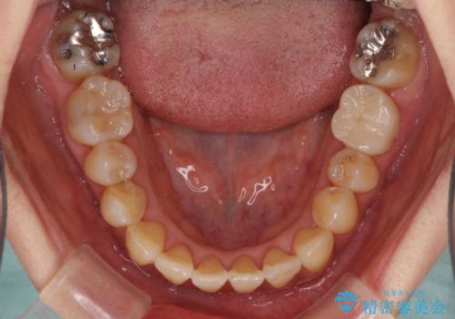 反対咬合で痛む前歯を改善 インビザラインによる矯正治療の治療中