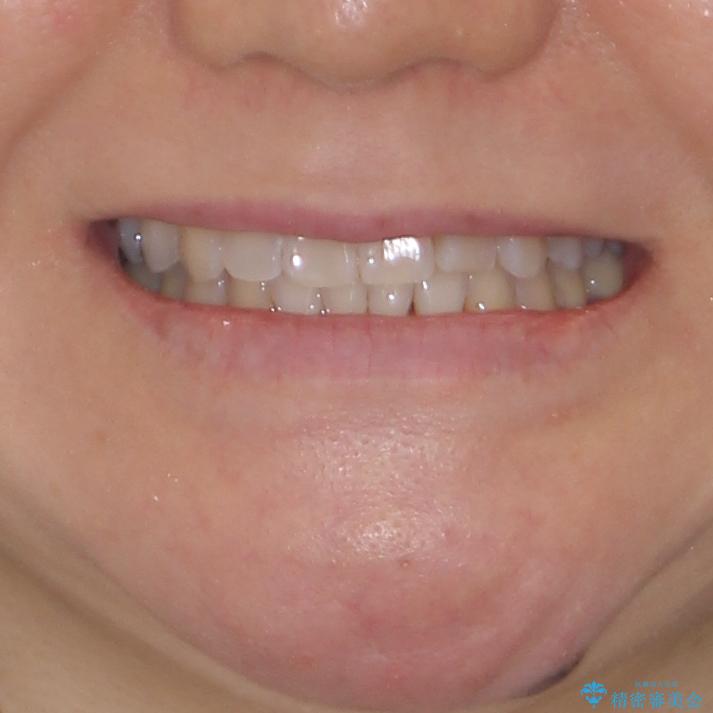 前歯のクロスバイト インビザライン矯正で改善の治療後(顔貌)