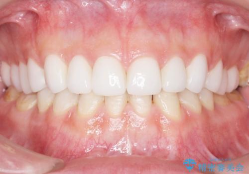 Kポップアイドルのような歯にしたい! 20代男性の治療後