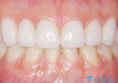 Kポップアイドルのような歯にしたい! 20代男性の治療後