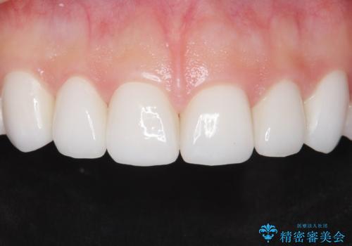 Kポップアイドルのような歯にしたい! 20代男性の症例 治療後