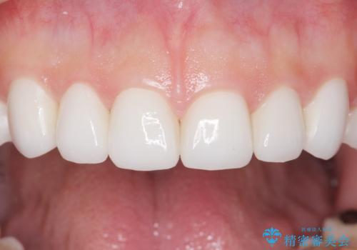 Kポップアイドルのような歯にしたい! 20代男性の治療後