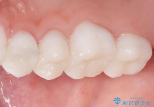 Kポップアイドルのような歯にしたい! 20代男性の治療後