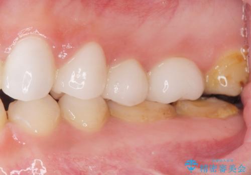 Kポップアイドルのような歯にしたい! 20代男性の治療後