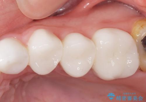 Kポップアイドルのような歯にしたい! 20代男性の治療後