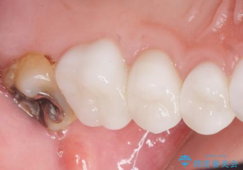 Kポップアイドルのような歯にしたい! 20代男性の治療後