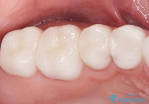 Kポップアイドルのような歯にしたい! 20代男性の治療後