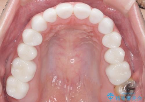 Kポップアイドルのような歯にしたい! 20代男性の治療後