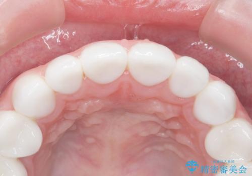 Kポップアイドルのような歯にしたい! 20代男性の治療後