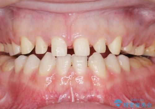 Kポップアイドルのような歯にしたい! 20代男性の治療中