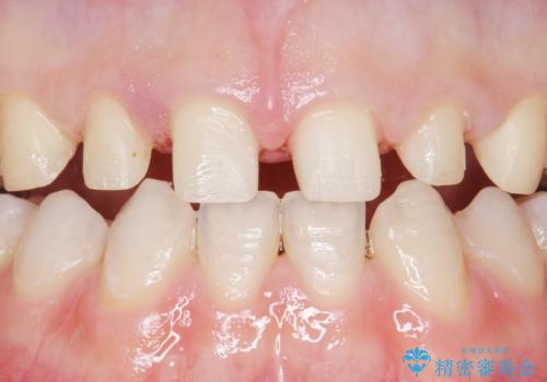 Kポップアイドルのような歯にしたい! 20代男性の治療中