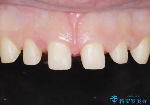 Kポップアイドルのような歯にしたい! 20代男性の治療中