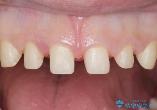 Kポップアイドルのような歯にしたい! 20代男性の治療中