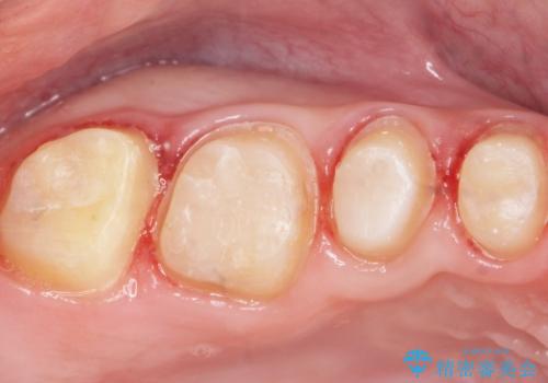 Kポップアイドルのような歯にしたい! 20代男性の治療中