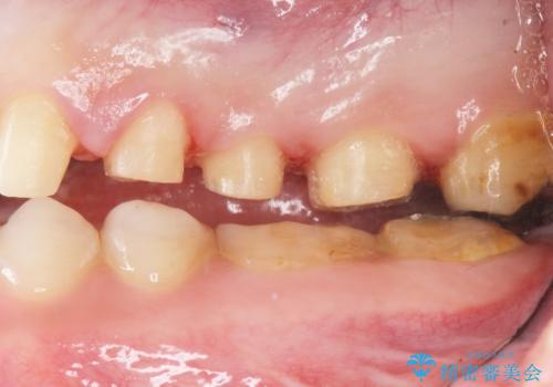 Kポップアイドルのような歯にしたい! 20代男性の治療中