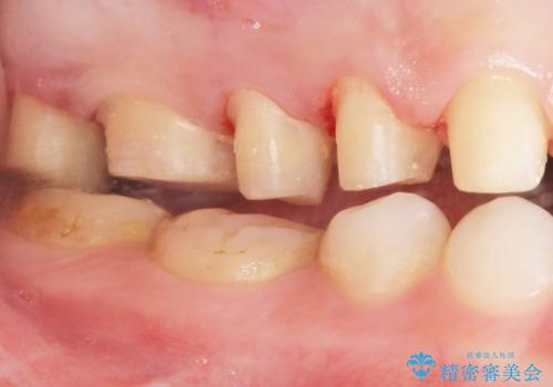 Kポップアイドルのような歯にしたい! 20代男性の治療中