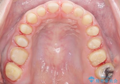 Kポップアイドルのような歯にしたい! 20代男性の治療中