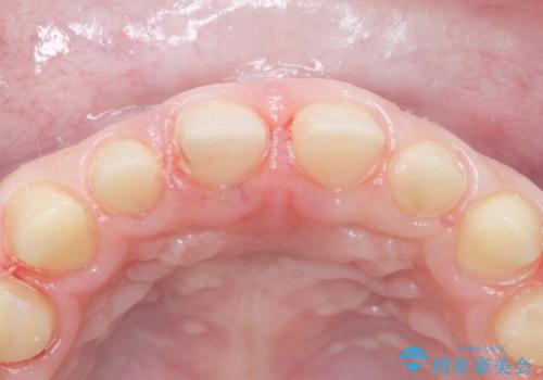 Kポップアイドルのような歯にしたい! 20代男性の治療中