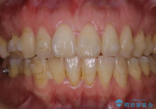 invisalignでのマウスピース矯正中もきれいな口元にの治療前