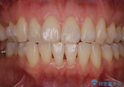 invisalignでのマウスピース矯正中もきれいな口元にの治療後
