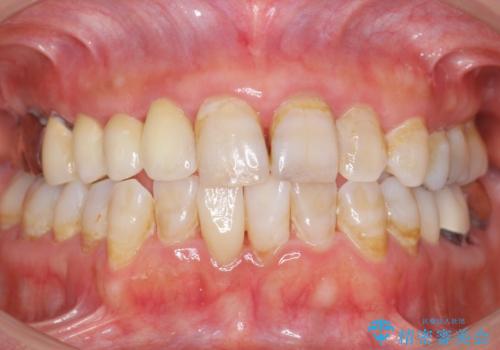 被せ物がかけた 綺麗で丈夫なセラミックのブリッジへ 60代女性の治療後