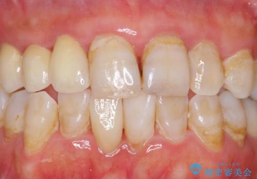 被せ物がかけた 綺麗で丈夫なセラミックのブリッジへ 60代女性の治療後